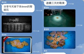 结石