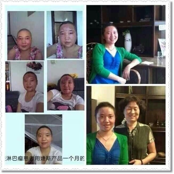 皮肤多发性淋巴瘤第四期，骨髓抑制第四期